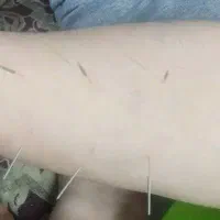 حجامت فصد ماساژطب سوزنی تزریقات بادکش