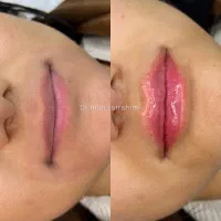 ژل-بوتاکس-فیلربادی-آمپول لاغری-توسط پزشک خانم