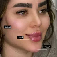 جشنواره عیدانه فیلر و بوتاکس فقط ۵۹۹در مطب