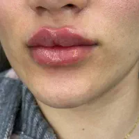 جشنواره تزریق فیلر نورامیس ۳۰% تخفیف