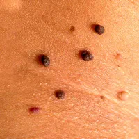 دستگاه خال برداری وزگیل برداری حتی جا های حساس