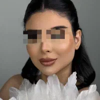 تخفیف فیلر صورت|خدمات آرایشگری و زیبایی|اهواز, زیتون کارمندی|دیوار