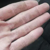 راهنمایی جهت رفع تیرگی پوست بدن