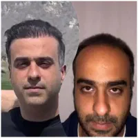 روش جدید بدون جراحی فول تراکم|خدمات آرایشگری و زیبایی|آمل, |دیوار