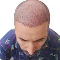 جشنواره کاشت مو و مزوتراپی|خدمات آرایشگری و زیبایی|مشهد, احمدآباد|دیوار