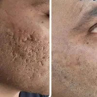 فیلر،بوتاکس،مزوتراپی،درمان منافذ باز و لک|خدمات آرایشگری و زیبایی|مشهد, وکیل‌آباد|دیوار