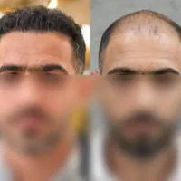 کاشت مو ریش و ابرو با ۳ میلیون