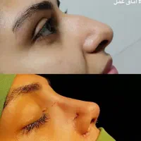 آفر ویژه عمل بینی /پلک /دندان/لیپوساکشن/غبغب|خدمات آرایشگری و زیبایی|شیراز, عفیف‌آباد|دیوار