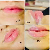 تزریق ژل وبوتاکس وprp ومزونیدلینگ وفشیال وهایفو