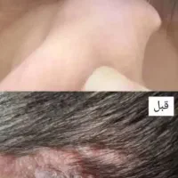 بهبودی ززگیل و تبخاال تظمینی|آرایشی، بهداشتی، درمانی|آبادان, |دیوار