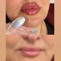 آف یلدایی ژل و بوتاکس|خدمات آرایشگری و زیبایی|دورود, |دیوار