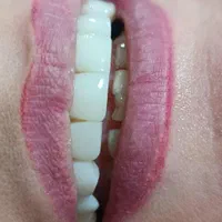 کامپوزیت دندان|خدمات آرایشگری و زیبایی|نورآباد, |دیوار