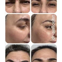 فیلر،ژل،بوتاکس، مزو ، پی ارپی مشاوره رایگان