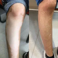 درمان ریشه ای و بدون بازگشت پیسی و پسوریازیس|آرایشی، بهداشتی، درمانی|شیراز, حافظیه|دیوار