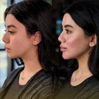 ژل لب ،زاویه سازی،فیلر چانه ،فول فیس|خدمات آرایشگری و زیبایی|مشهد, سجاد شهر|دیوار