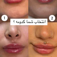 نیاز به لیزر بهمراه دستگاه لیزر یا فیشیالیست