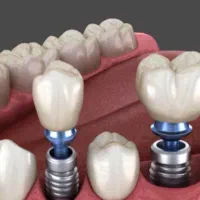دندانپزشکی ایمپلنت