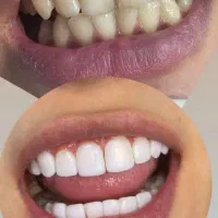 جشنواره کامپوزیت دندان|خدمات آرایشگری و زیبایی|شاهرود, |دیوار