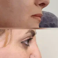 عمل بینی با متخصص گوش حلق وبینی/اقساطی/فقط ۷۰ تومن