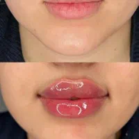 تخفیفات ژل وبوتاکس، فیلربادی ویژه کلینیک
