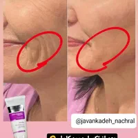 چین و چروک|آرایشی، بهداشتی، درمانی|تهران, جابری|دیوار