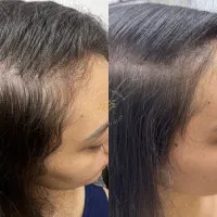 قطع ریزش در دوهفته|آرایشی، بهداشتی، درمانی|خوسف, |دیوار