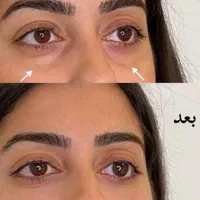 ژل لب زاویه چانه گونه  مزوبوتاکس هایفو لیزرمو زائد|خدمات آرایشگری و زیبایی|مشهد, فرهنگ|دیوار
