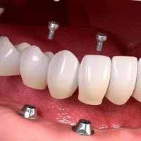 کلینیک تخصصی، دیجیتالی ایمپلنت و کاشت دندان حـامـی