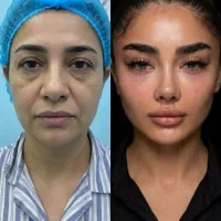 جراحی بینی،شقیقه،لیپو،بازو،کانتور صورت