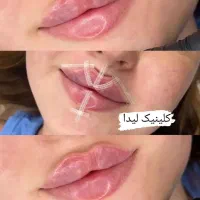 جشنواره یلدایی ژل لب فیلر890بوتاکس690 پزشک متخصص