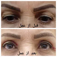 عملهای زیبایی پلک،بینی،گوش ،ساکشن غبغب،سانترال لب|خدمات آرایشگری و زیبایی|اهواز, طالقانی|دیوار