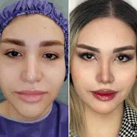 جراحی زیبایی عمل بینی، لیفت صورت و پیکرتراشی|خدمات زیبایی و سلامت|کرج, عظیمیه|دیوار