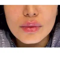 تزریق فیلر بوتاکس۳۴۹ لیزر زاویه متدmd codeمزوپزشک|خدمات زیبایی و سلامت|تهران, طرشت|دیوار