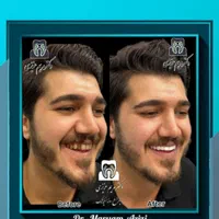 پایتخت لمینت کامپوزیت دندان ، خدمات دندانپزشکی|خدمات آرایشگری و زیبایی|شیراز, معالی‌آباد|دیوار
