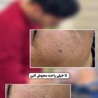 خالبرداری بدون جراحی در کلینیک زیبایی و لیزر راویس|خدمات آرایشگری و زیبایی|کاشان, رجایی|دیوار