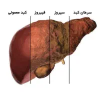 کبد چرب مرگ خاموش،