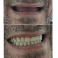 کلینک تخصصی دندان مصنوعی فقط 6.800|خدمات آرایشگری و زیبایی|بهارستان, |دیوار