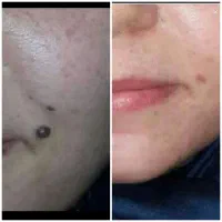برداشت ککومک ولک رفع ترک پوستی چین وچروک جای زخم