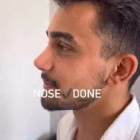 عمل بینی ( فقط ۳۱میلیون)