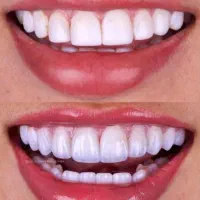 دندانپزشکی زیبایی|خدمات آرایشگری و زیبایی|تهران, ازگل|دیوار