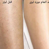 لیزر مو های زائد باکیفیت بالا هزینه پایین|استخدام درمانی، زیبایی، بهداشتی|اهواز, کمپلو جنوبی|دیوار