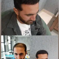 کاشت مو تخصصی|خدمات آرایشگری و زیبایی|تبریز, |دیوار