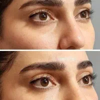 رفع تیرگی و گودی با تزریق فیلر زیر چشم توسط پزشک|خدمات آرایشگری و زیبایی|قم, بکایی|دیوار