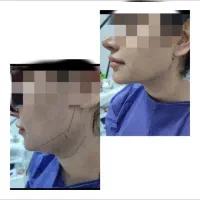 ساکشن غبغب سوپر کانتور