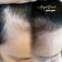 رشد ۴برابری مو سر ابرو تک جلسه گارا نتی یلدا