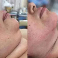 ساکشن(تخلیه) و تزریق بدن و صورت تخصصی در کلینیک|خدمات آرایشگری و زیبایی|اهواز, کیانپارس |دیوار