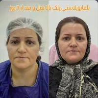 بلفاروپلاستی پلک بالا به مدت محدود فقط 8 میلیون|خدمات آرایشگری و زیبایی|بوکان, |دیوار