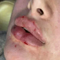 فیلربینی ژل لب روسی متدMمادلینگ خط لبخندگونه شقیقه|خدمات زیبایی و سلامت|تهران, پونک|دیوار