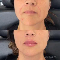 لیفت صورت نخ،ژل لب بوتاکس هایفو لیزر موتیتانیومprp|خدمات آرایشگری و زیبایی|مشهد, وکیل‌آباد|دیوار