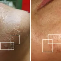 لیزر موهای زائد و الکترولیز|خدمات آرایشگری و زیبایی|شیراز, سعدیه شمالی|دیوار